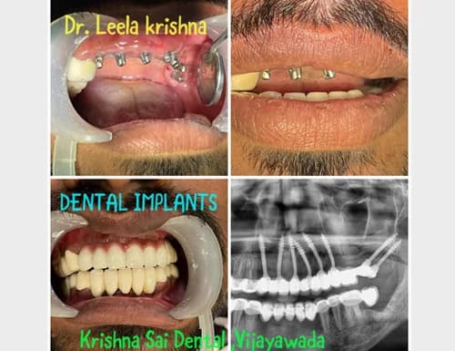 Full arch immediate loading basal implants post-op OPG X-ray verification