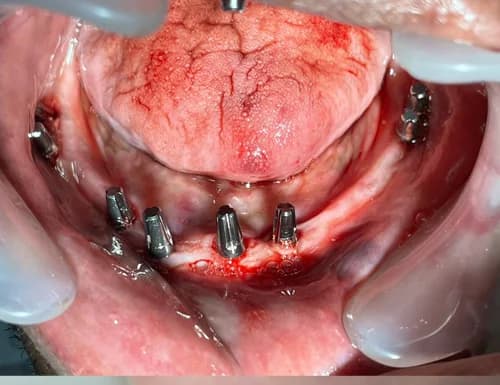 Sterile surgical placement of basal cortical implants in anterior mandible