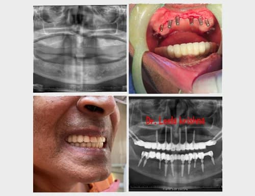 Maxillary & Mandibular Implant Fixed Restoration