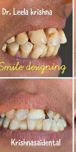 Direct Aesthetic Smile Designing & Alignment - Before