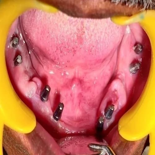 Immediate Loading Basal Implants