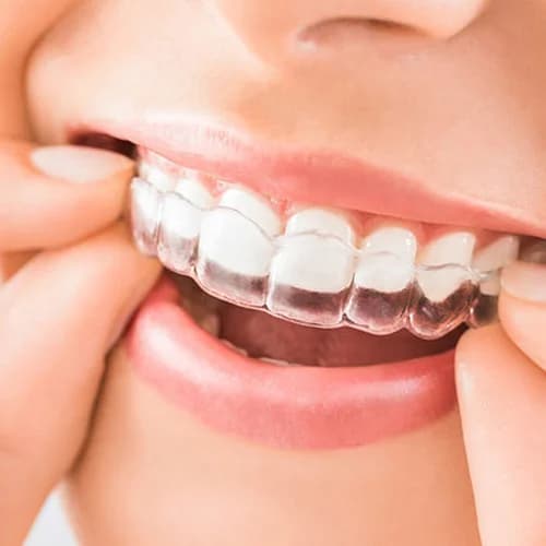 Clear Aligners & Invisible Braces
