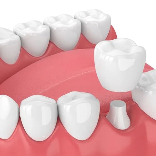 Single-Visit Rotary Root Canal (RCT)