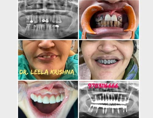 Severe Decay & Periodontitis to Bright White Smile