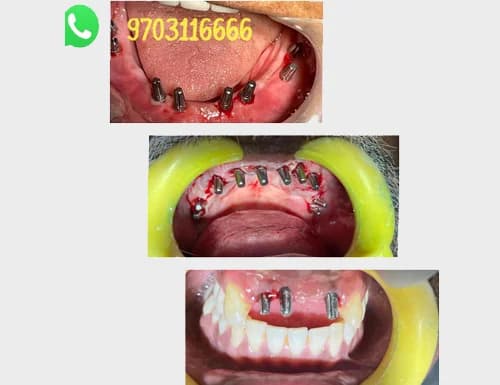 Immediate Basal Cortical Abutment Surgical Alignment