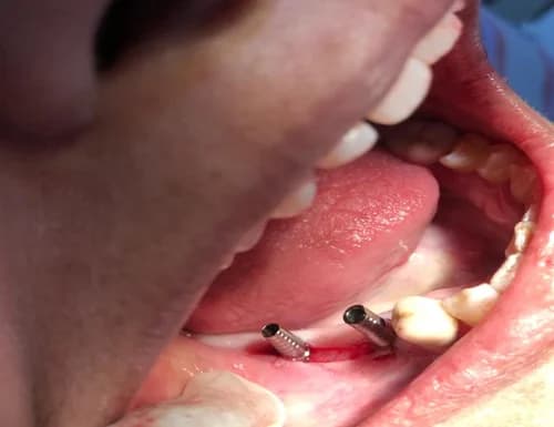 Posterior Mandibular Basal Implant Fixation