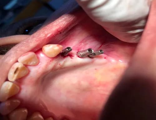 Posterior Maxillary Cortical Anchorage View