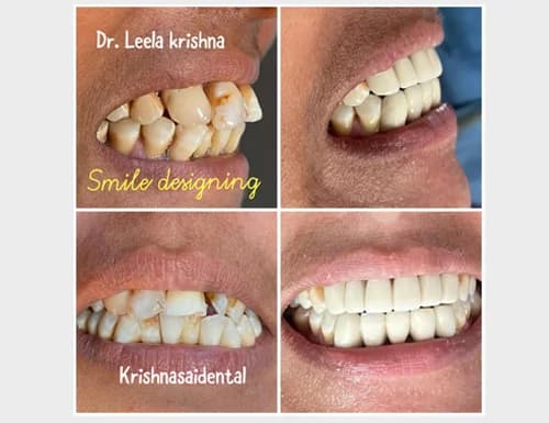 Direct Smile Designing & Aesthetic Alignment