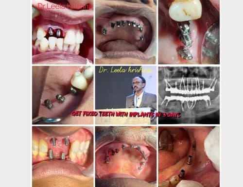 Fixed Teeth with Implants in 3 Days - Masterclass Case