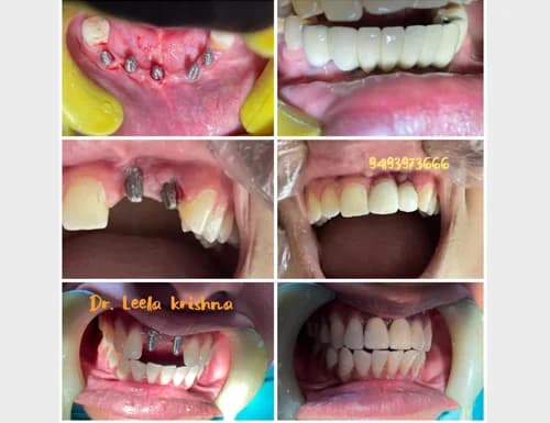 Multiple Anterior & Posterior Implant Restorations