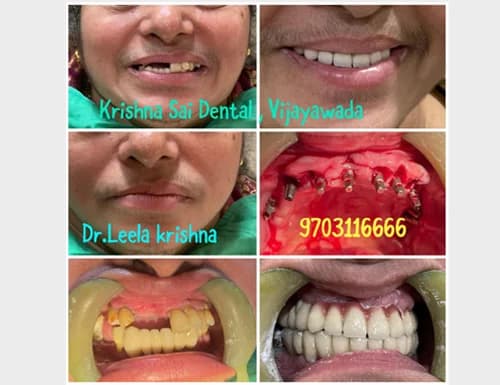 Full Arch Fixed Teeth for Senior Citizen