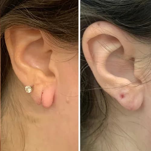 Sutureless Aesthetic Earlobe Defect Repair
