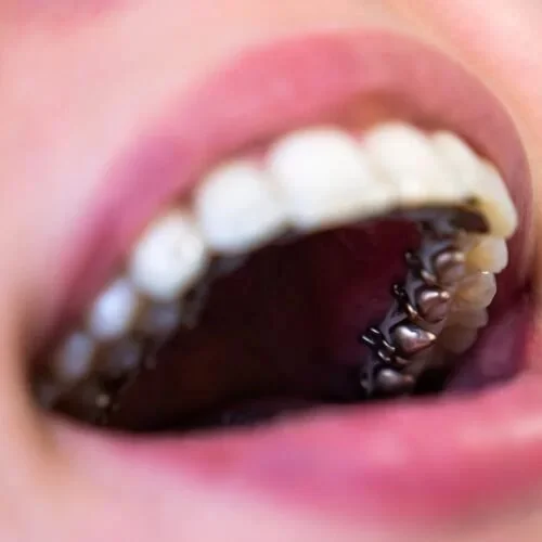 Invisible Lingual Braces (Behind Teeth)