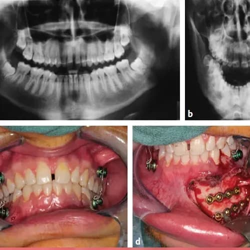 Maxillofacial Trauma: Jaw Fracture Mini-Plate Plating