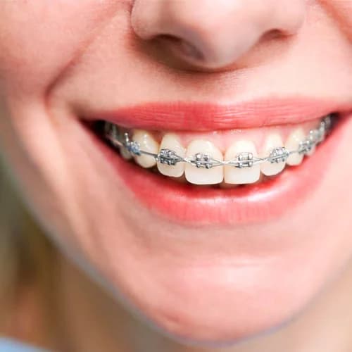 Orthodontic Metal Braces Smile