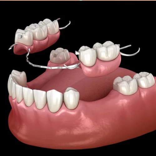 Precision Cast Partial Denture Model