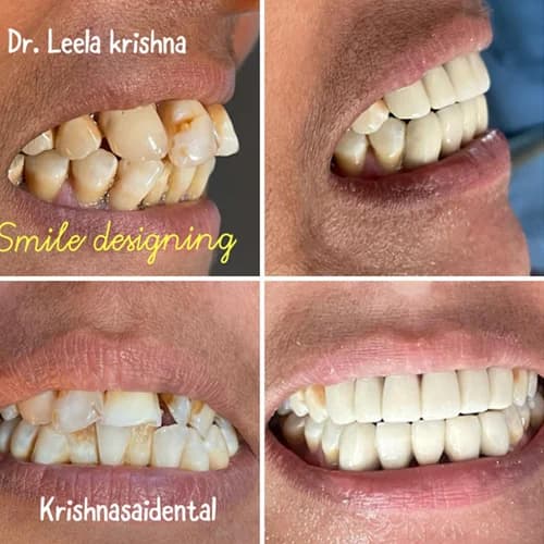 Dr. Leela Krishna Smile Designing Before/After
