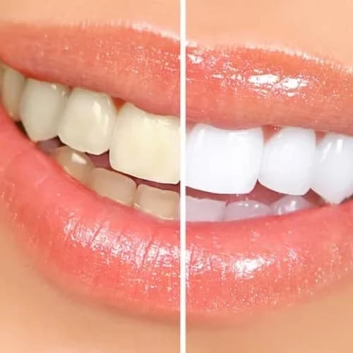 In-Office Dental Whitening Split Comparison