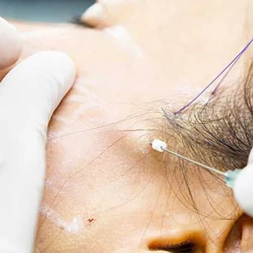 Minimally Invasive Aesthetic Thread Lift